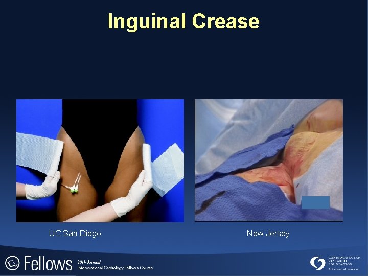 Inguinal Crease UC San Diego New Jersey 