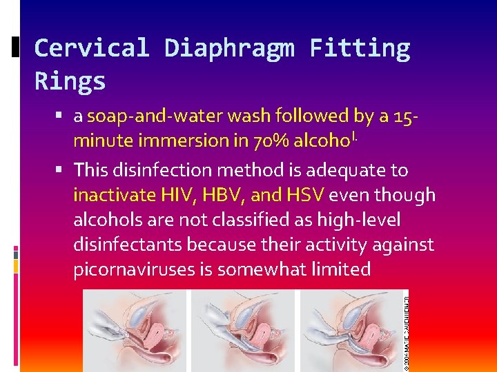 Cervical Diaphragm Fitting Rings a soap-and-water wash followed by a 15 minute immersion in