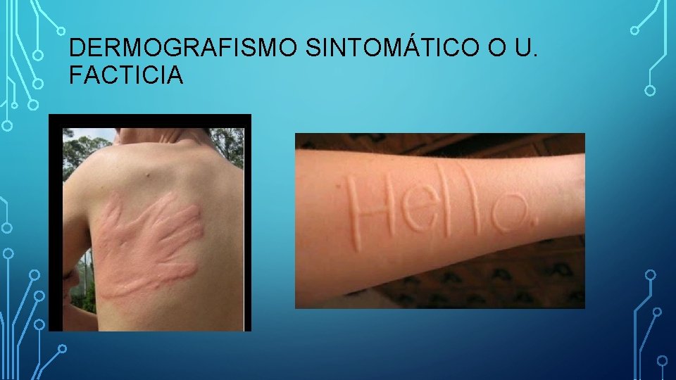 DERMOGRAFISMO SINTOMÁTICO O U. FACTICIA DERMOGRAFISMO SINTOMÁTICO O U. FACTICIA