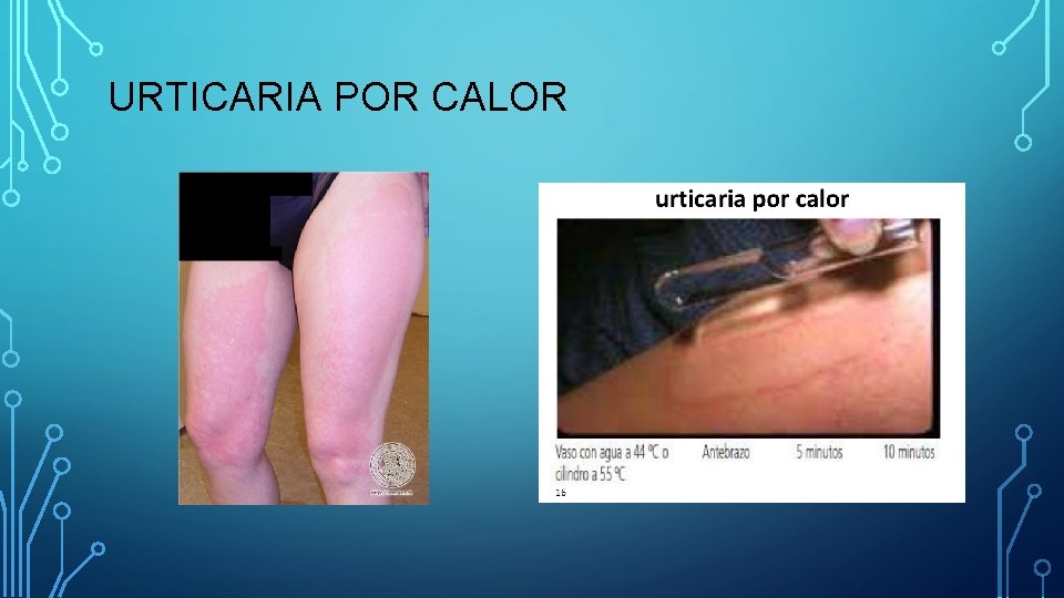 URTICARIA POR CALOR URTICARIA POR CALOR