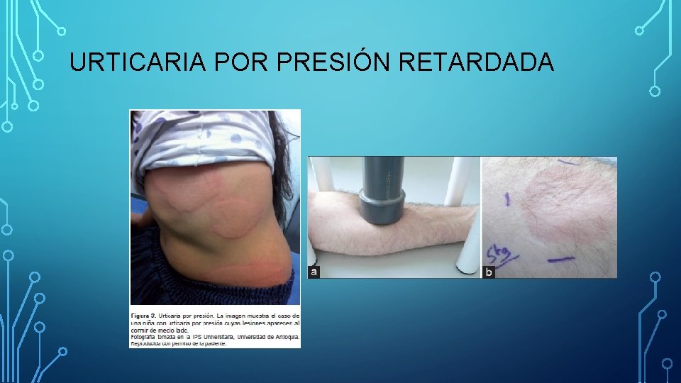 URTICARIA POR PRESIÓN RETARDADA URTICARIA POR PRESIÓN RETARDADA