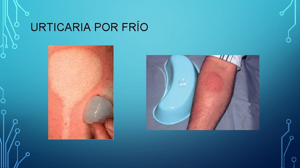 URTICARIA POR FRÍO URTICARIA POR FRÍO