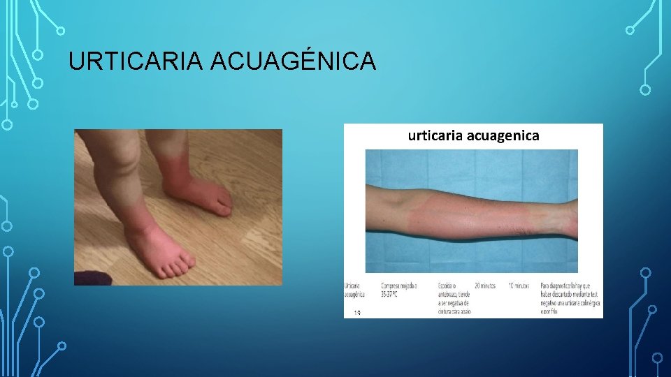 URTICARIA ACUAGÉNICA URTICARIA ACUAGÉNICA
