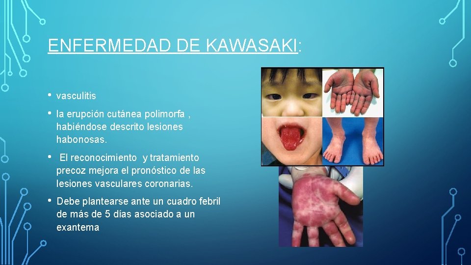 ENFERMEDAD DE KAWASAKI: • • vasculitis • El reconocimiento y tratamiento precoz mejora el ENFERMEDAD DE KAWASAKI: • • vasculitis • El reconocimiento y tratamiento precoz mejora el