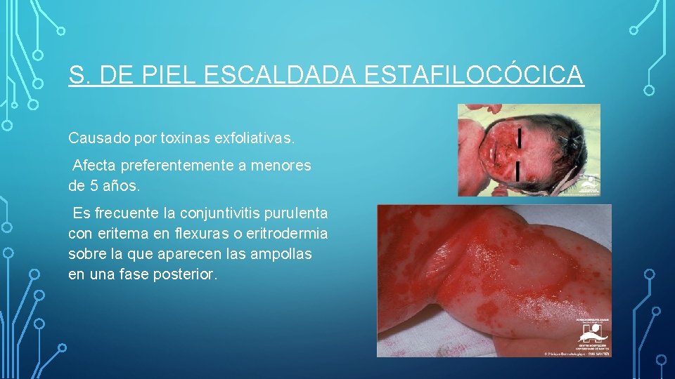 S. DE PIEL ESCALDADA ESTAFILOCÓCICA Causado por toxinas exfoliativas. Afecta preferentemente a menores de S. DE PIEL ESCALDADA ESTAFILOCÓCICA Causado por toxinas exfoliativas. Afecta preferentemente a menores de