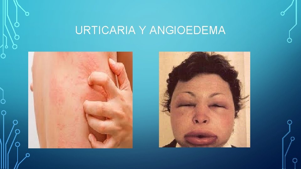 URTICARIA Y ANGIOEDEMA URTICARIA Y ANGIOEDEMA