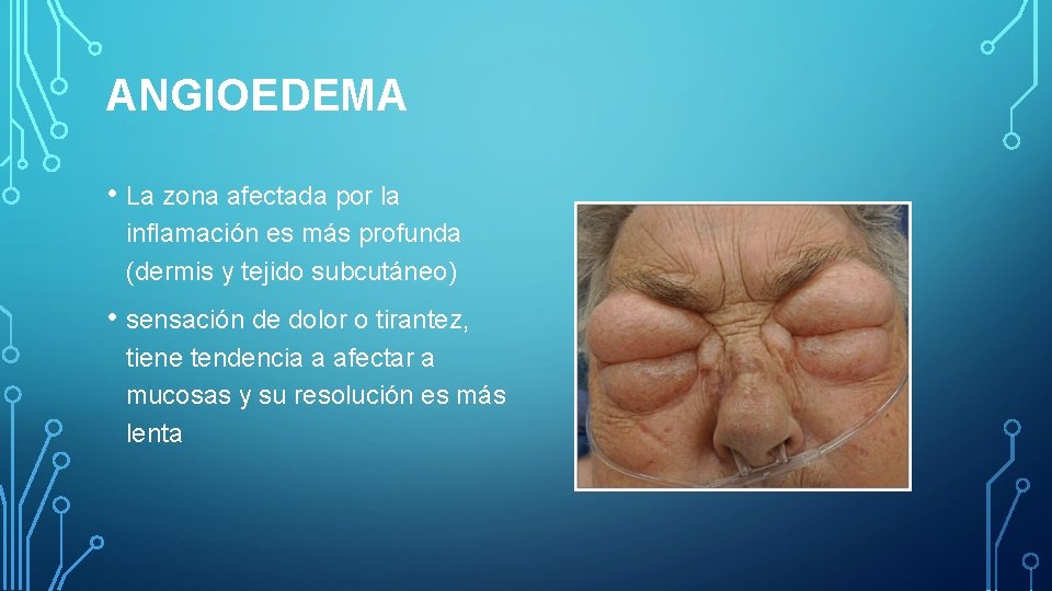 ANGIOEDEMA • La zona afectada por la inflamación es más profunda (dermis y tejido ANGIOEDEMA • La zona afectada por la inflamación es más profunda (dermis y tejido