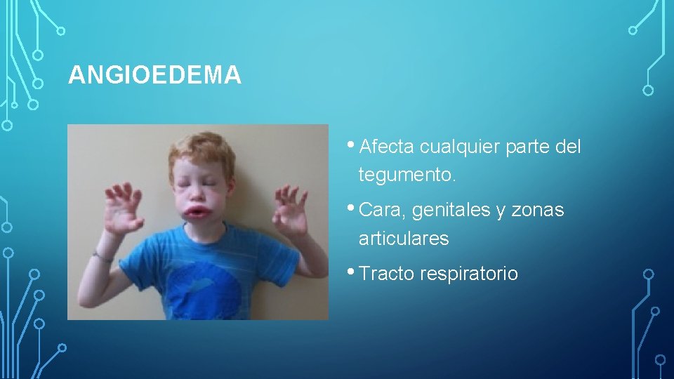 ANGIOEDEMA • Afecta cualquier parte del tegumento. • Cara, genitales y zonas articulares • ANGIOEDEMA • Afecta cualquier parte del tegumento. • Cara, genitales y zonas articulares •