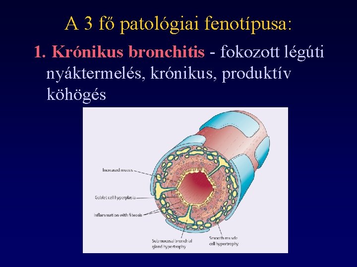A 3 fő patológiai fenotípusa: 1. Krónikus bronchitis - fokozott légúti nyáktermelés, krónikus, produktív