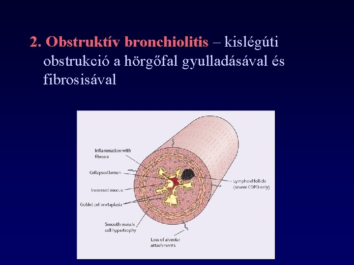 2. Obstruktív bronchiolitis – kislégúti obstrukció a hörgőfal gyulladásával és fibrosisával 