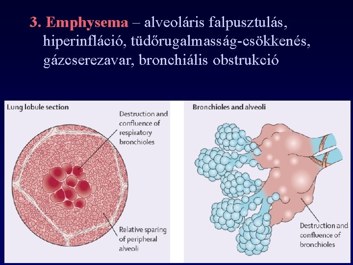 3. Emphysema – alveoláris falpusztulás, hiperinfláció, tüdőrugalmasság-csökkenés, gázcserezavar, bronchiális obstrukció 