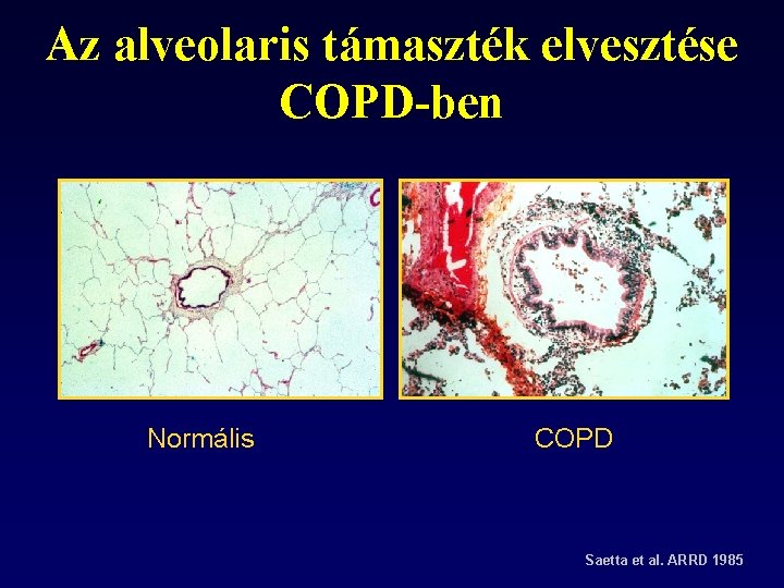 Az alveolaris támaszték elvesztése COPD-ben Normális COPD Saetta et al. ARRD 1985 