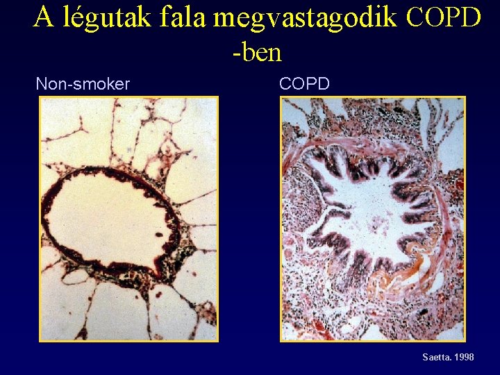 A légutak fala megvastagodik COPD -ben Non-smoker COPD Saetta. 1998 