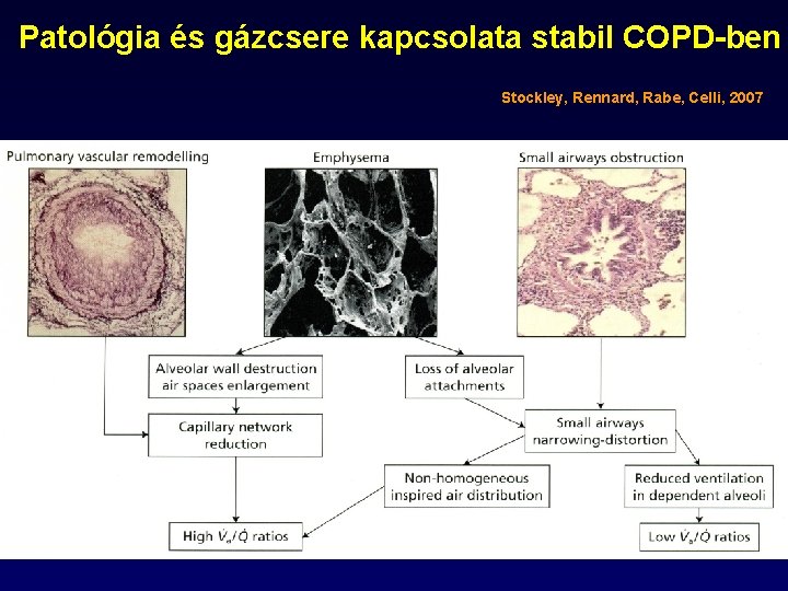 Patológia és gázcsere kapcsolata stabil COPD-ben Stockley, Rennard, Rabe, Celli, 2007 