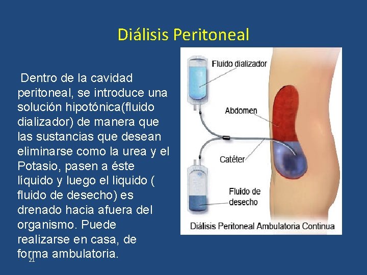 Diálisis Peritoneal Dentro de la cavidad peritoneal, se introduce una solución hipotónica(fluido dializador) de