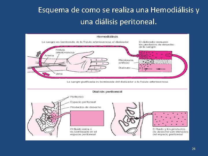 Esquema de como se realiza una Hemodiálisis y una diálisis peritoneal. 24 