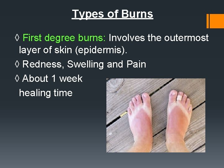 Types of Burns ◊ First degree burns: Involves the outermost layer of skin (epidermis).