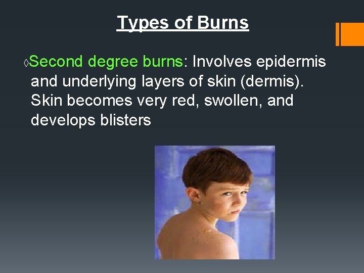 Types of Burns ◊ Second degree burns: Involves epidermis and underlying layers of skin