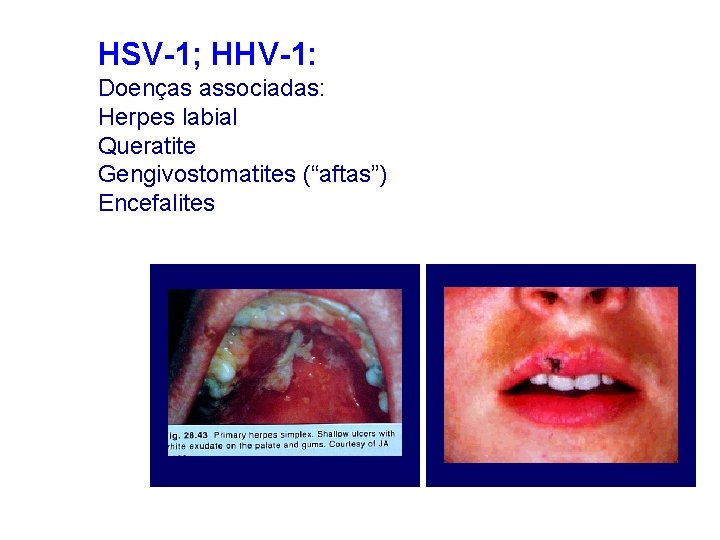 HSV-1; HHV-1: Doenças associadas: Herpes labial Queratite Gengivostomatites (“aftas”) Encefalites 