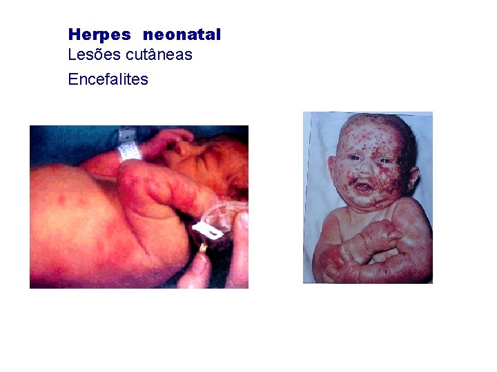 Herpes neonatal Lesões cutâneas Encefalites 