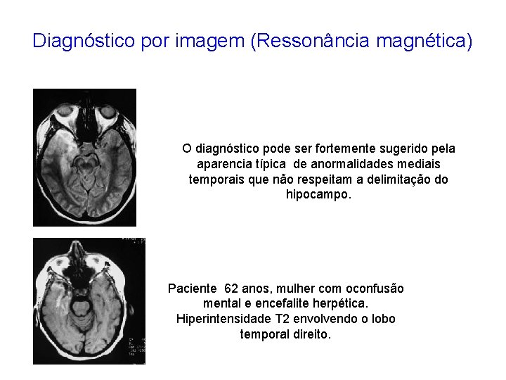 Diagnóstico por imagem (Ressonância magnética) O diagnóstico pode ser fortemente sugerido pela aparencia típica