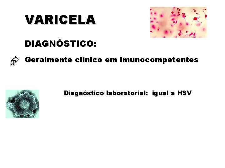 VARICELA DIAGNÓSTICO: Geralmente clínico em imunocompetentes Diagnóstico laboratorial: igual a HSV 