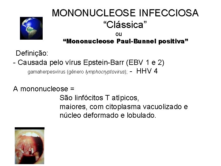 MONONUCLEOSE INFECCIOSA “Clássica” ou “Mononucleose Paul-Bunnel positiva” Definição: - Causada pelo vírus Epstein-Barr (EBV