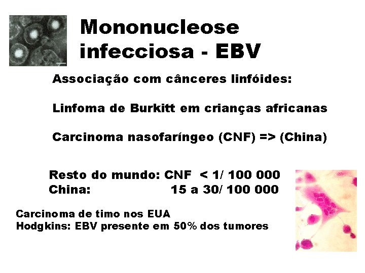 Mononucleose infecciosa - EBV Associação com cânceres linfóides: Linfoma de Burkitt em crianças africanas