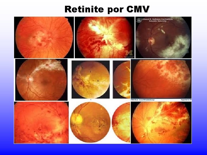 Retinite por CMV 