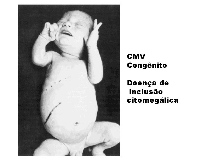 CMV Congênito Doença de inclusão citomegálica 