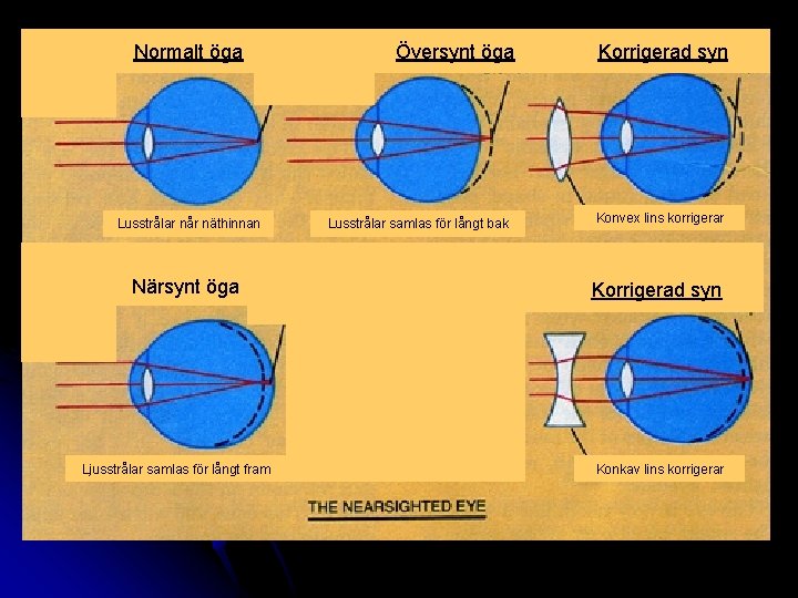 Normalt öga Lusstrålar når näthinnan Närsyntöga Närsynt Ljusstrålar samlas för långt fram Översynt öga