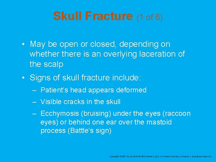 Skull Fracture (1 of 6) • May be open or closed, depending on whethere