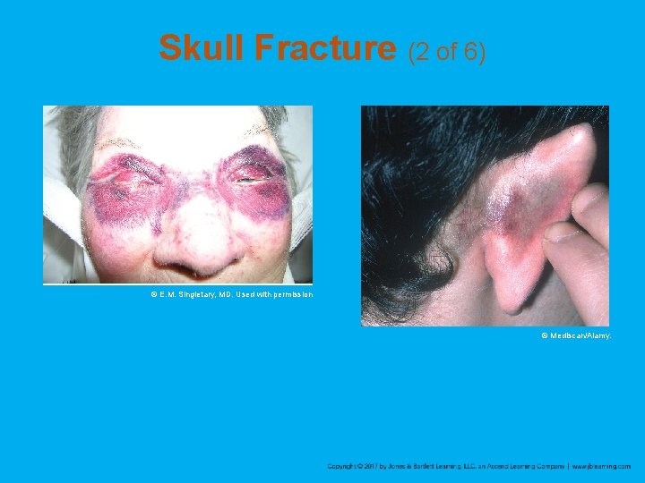 Skull Fracture (2 of 6) © E. M. Singletary, MD. Used with permission ©