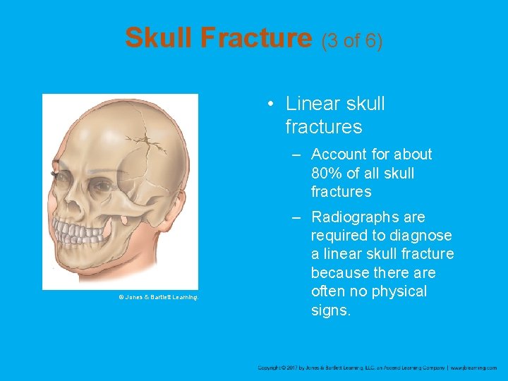 Skull Fracture (3 of 6) • Linear skull fractures – Account for about 80%