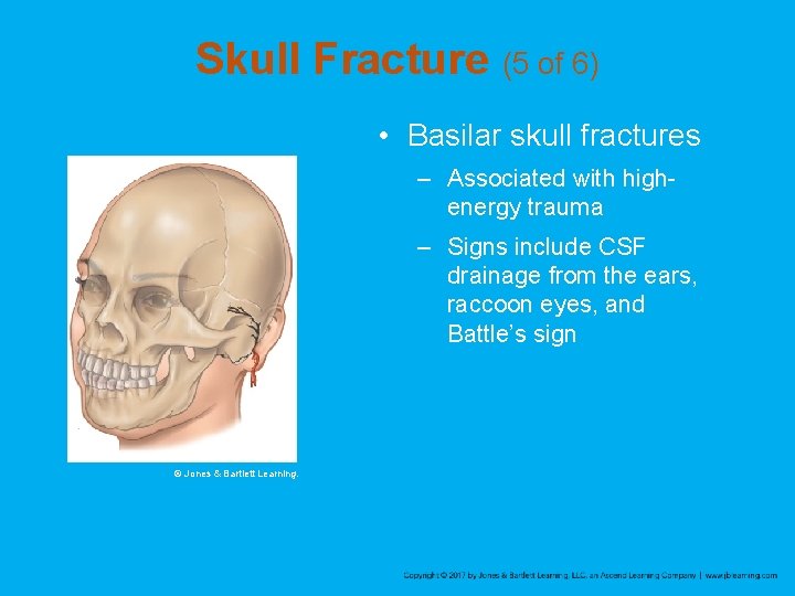 Skull Fracture (5 of 6) • Basilar skull fractures – Associated with highenergy trauma