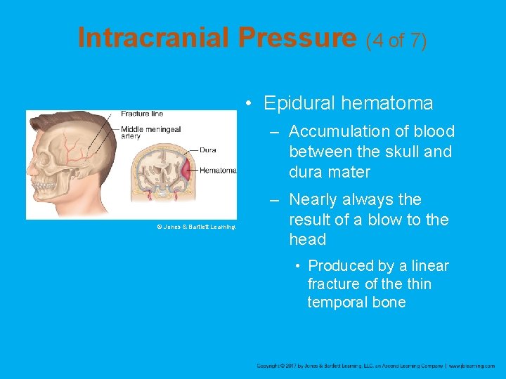 Intracranial Pressure (4 of 7) • Epidural hematoma – Accumulation of blood between the