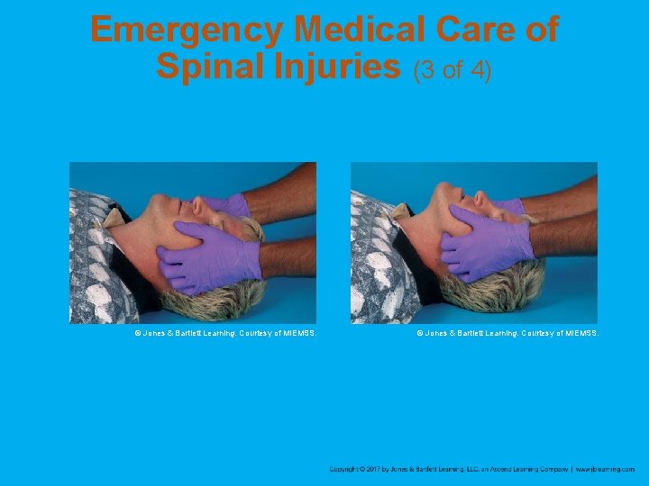 Emergency Medical Care of Spinal Injuries (3 of 4) © Jones & Bartlett Learning.