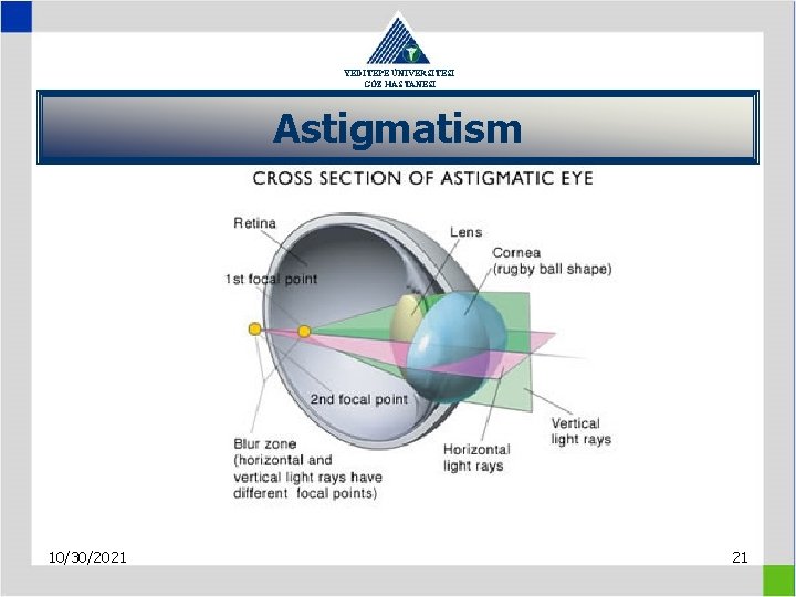 YEDİTEPE ÜNİVERSİTESİ GÖZ HASTANESİ Astigmatism 10/30/2021 21 