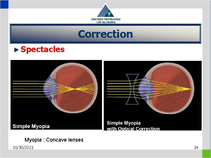 YEDİTEPE ÜNİVERSİTESİ GÖZ HASTANESİ Correction Spectacles Myopia : Concave lenses 10/30/2021 24 