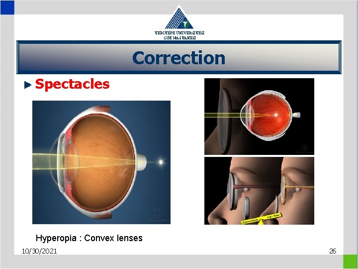 YEDİTEPE ÜNİVERSİTESİ GÖZ HASTANESİ Correction Spectacles Hyperopia : Convex lenses 10/30/2021 26 