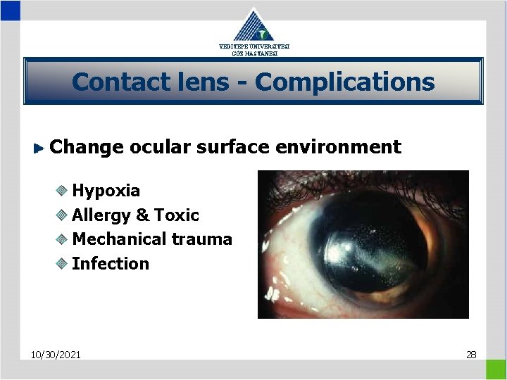 YEDİTEPE ÜNİVERSİTESİ GÖZ HASTANESİ Contact lens - Complications Change ocular surface environment Hypoxia Allergy