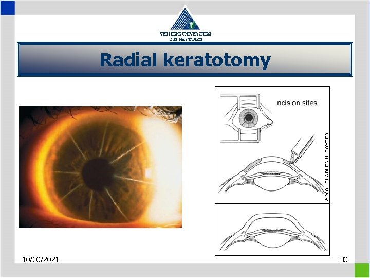 YEDİTEPE ÜNİVERSİTESİ GÖZ HASTANESİ Radial keratotomy 10/30/2021 30 