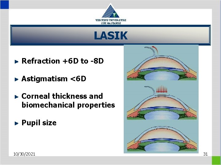 YEDİTEPE ÜNİVERSİTESİ GÖZ HASTANESİ LASIK Refraction +6 D to -8 D Astigmatism <6 D