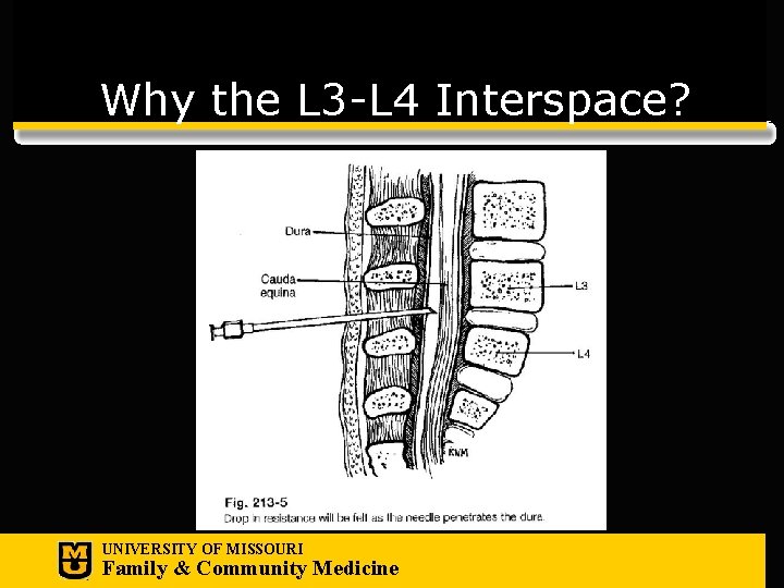 Why the L 3 -L 4 Interspace? UNIVERSITY OF MISSOURI Family & Community Medicine