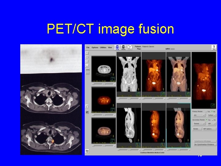 PET/CT image fusion 10 