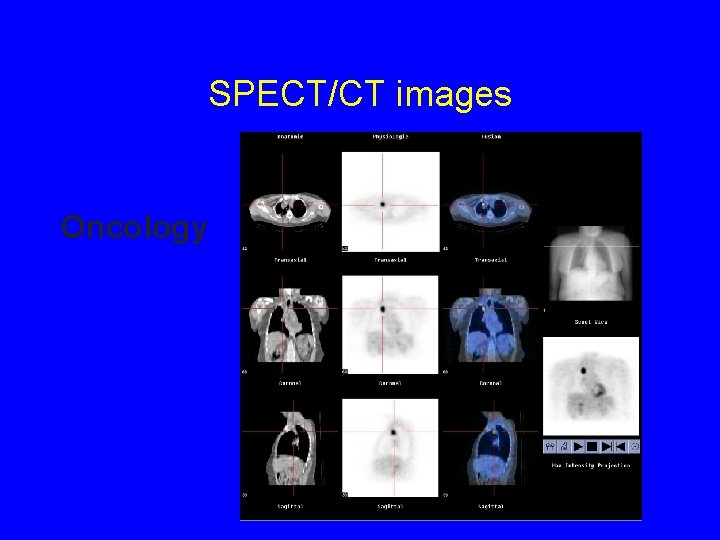 SPECT/CT images Oncology 