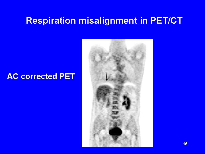Respiration misalignment in PET/CT AC corrected PET 15 