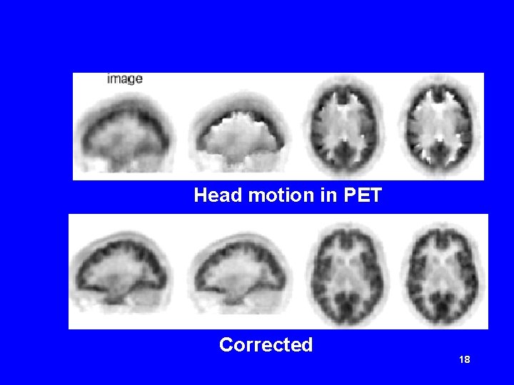 Head motion in PET Corrected 18 