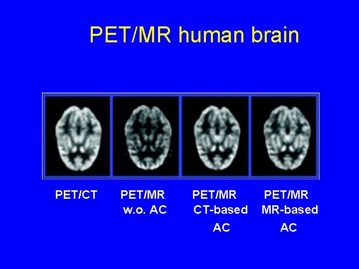 PET/MR human brain PET/CT PET/MR w. o. AC PET/MR CT-based PET/MR MR-based AC AC