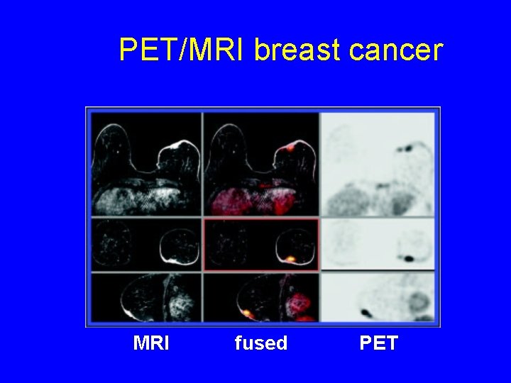 PET/MRI breast cancer MRI fused PET 
